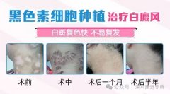 關於白癜風的手術治療